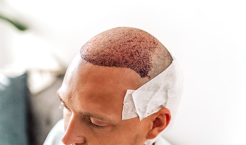 hair line post hair transplant