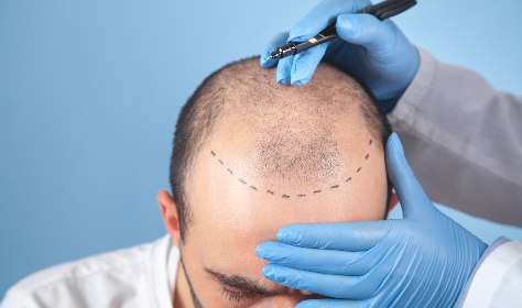 Does Donor Area Hair Grow Back After Hair Transplant?