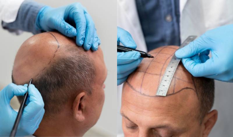hair line post hair transplant