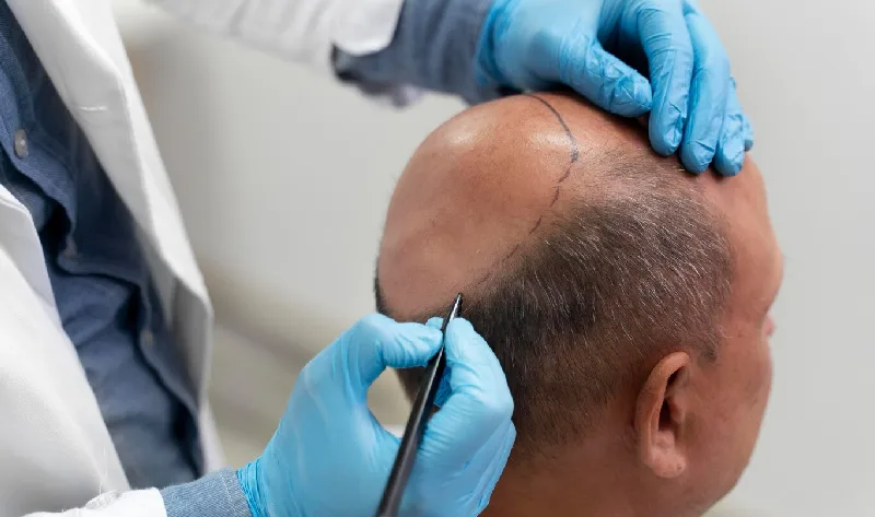 Important Things to Consider Before Getting a Hair Transplant