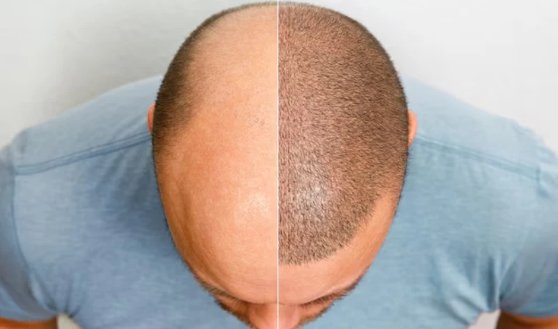hair line post hair transplant