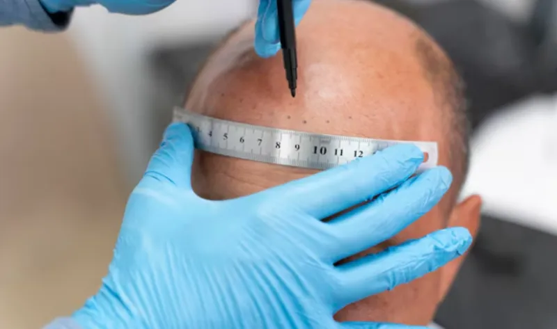 hair line post hair transplant