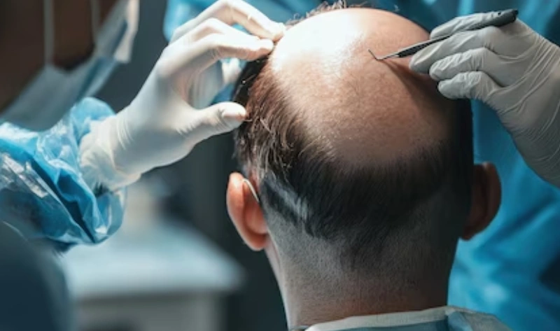 hair line post hair transplant