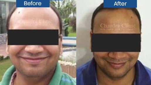 View Hair Transplant Surgery Before and After photos of successful results by Dr. Urvashi Chandra.