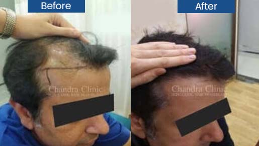 Hair Loss Treatment in Delhi
