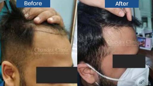 Hair Transplant in Delhi
