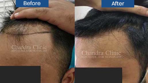 Hair transplant surgery in Delhi