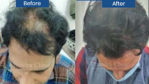 Hair Transplantation