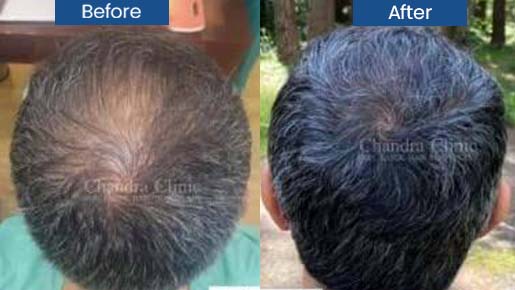 Hair Loss Treatment