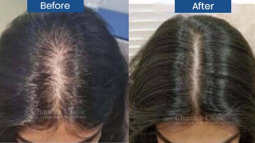 Hair Loss Treatment For women