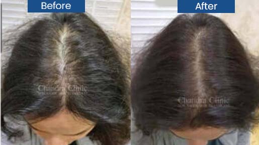 Hair Transplant For Women