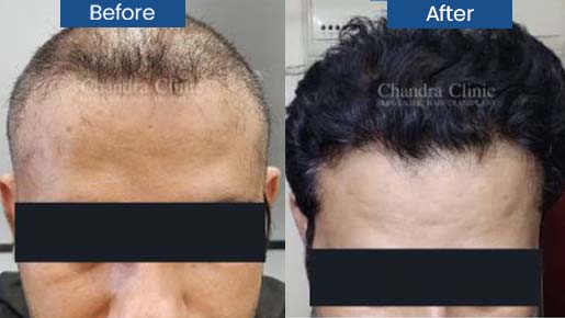 Hair Transplant