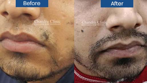 Moustache Restoration