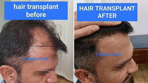 View Hair Transplant Before and After photos by Dr. Urvashi Chandra for remarkable results.
