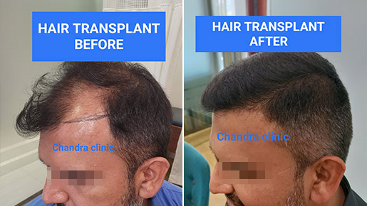 View Hair Transplant Before and After photos by Dr. Urvashi Chandra for remarkable results.