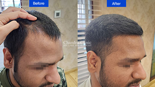 View BIO-IPT hair transplant Before and After photos of successful results by Dr. Urvashi Chandra.
