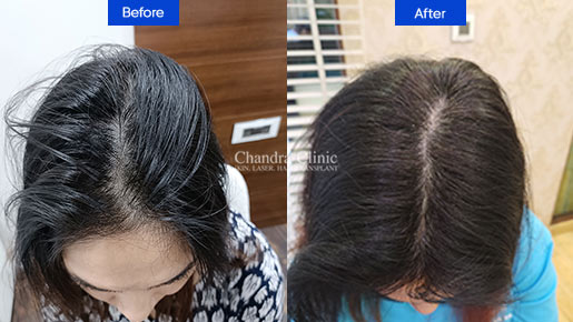 Real Result Three Hair Transplant in Delhi
