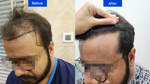 Hair Transplant Treatment