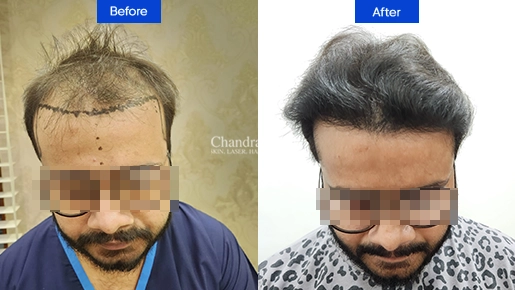 Hair Transplant Treatment