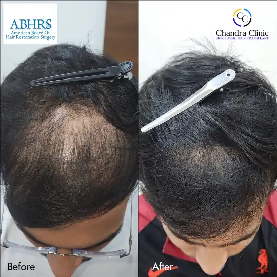 View GFC Therapy Before and After photos of successful results by Dr. Urvashi Chandra.