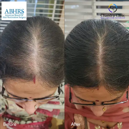 View GFC Therapy Before and After photos of successful results by Dr. Urvashi Chandra.
