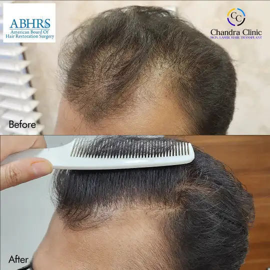 View GFC Therapy Before and After photos of successful results by Dr. Urvashi Chandra.