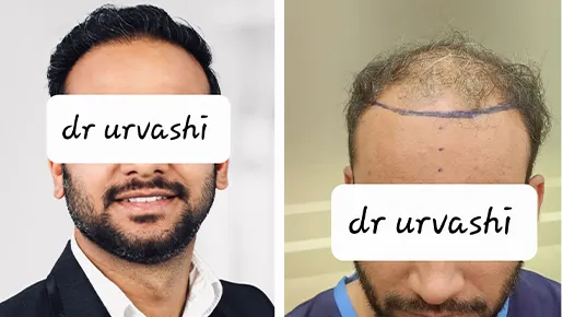 Hair Transplant Surgery Before and After | Hair Transplant Surgery Before and After Results