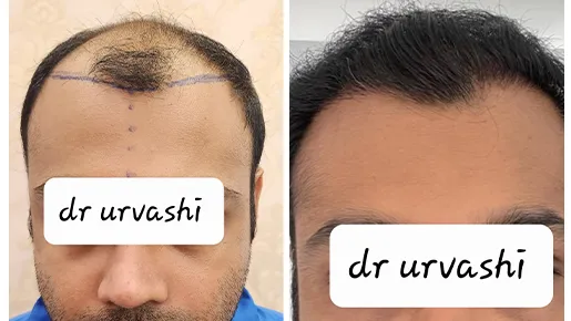 Hair Transplant Surgery Before and After | Hair Transplant Surgery Before and After Results
