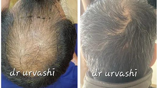 Hair Transplant Surgery Before and After | Hair Transplant Surgery Before and After Results