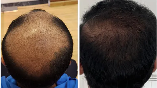 Hair Transplant Surgery Before and After | Hair Transplant Surgery Before and After Results