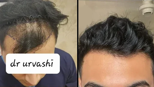 Hair Transplant Surgery Before and After | Hair Transplant Surgery Before and After Results