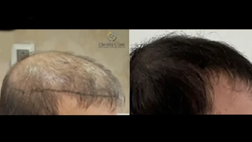 GFC Therapy Before and After