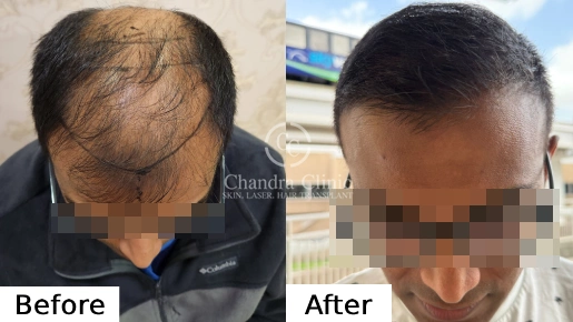 Hair Transplant Surgery Before and After Results