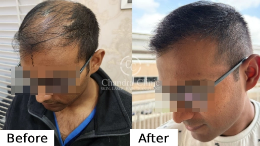 Hair Transplant Surgery Before and After Results