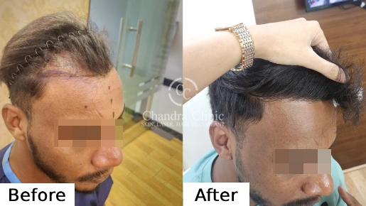 Hair Transplant Surgery Before and After Results