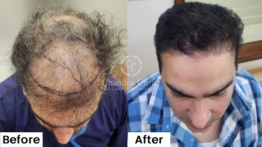 GFC Therapy Before and After