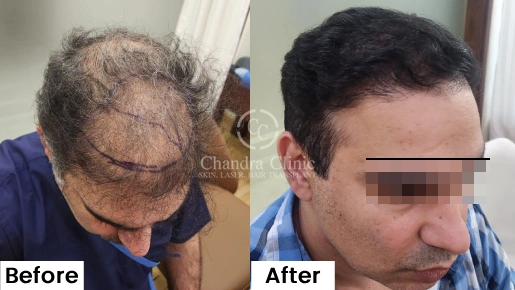 GFC Therapy Before and After