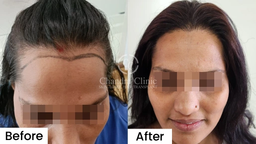 GFC Therapy Before and After | GFC Therapy Before and After Results