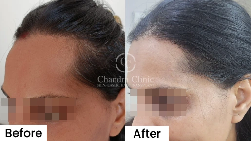 GFC Therapy Before and After | GFC Therapy Before and After Results