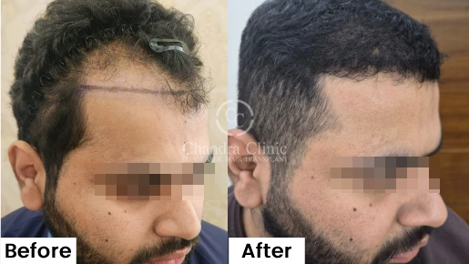 Hair Transplant Surgery Before and After Results