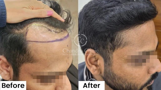Hair Transplant Surgery Before and After Results