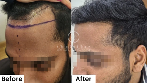 Hair Transplant Surgery Before and After Results