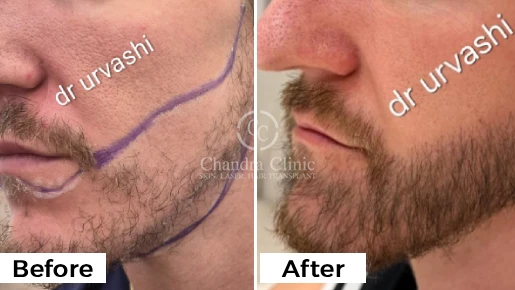 Beard Hair Transplant