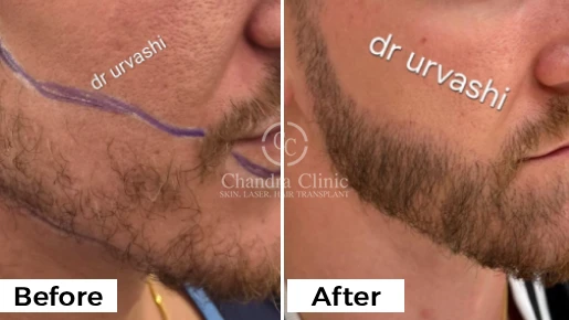 Beard Hair Transplant