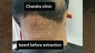 excellent beard hair transplant result! byDr.UrvashiChandra #besthairtransplant #beardhairtransplant
