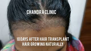 easy unshaven hair transplant in women or men is now so smooth! #unshavenhairtransplant