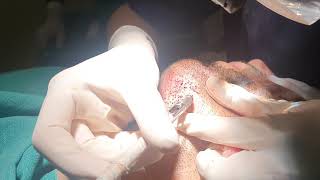 Dr. Urvashi chandra (Chandra clinic) beard hair extraction