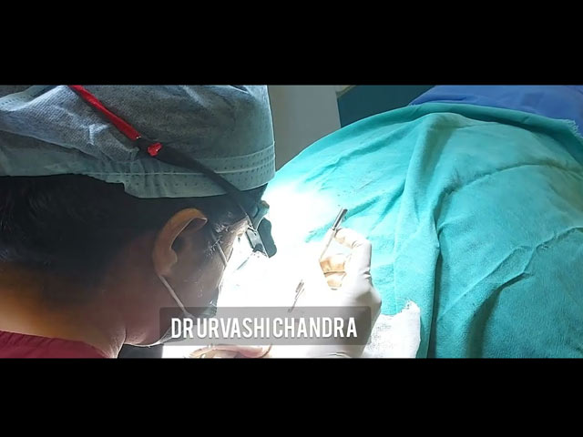 BIO IPT Hair Transplant: The Ultimate Solution to Your Hair Loss Woes