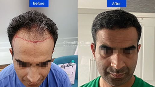 View BIO-IPT hair transplant Before and After photos of successful results by Dr. Urvashi Chandra.