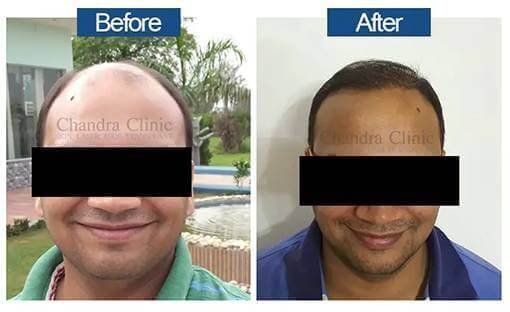 View Hair Transplant Surgery Before and After photos of successful results by Dr. Urvashi Chandra.